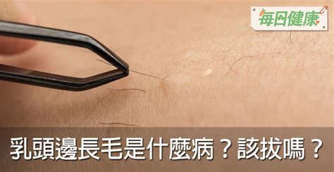 乳頭長毛|乳頭邊長了毛，是什麼病？該不該拔？讓名醫一次解釋給您聽｜每